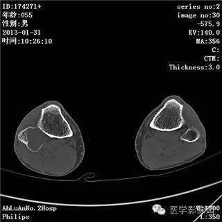 【病例】腓骨骨巨细胞瘤1例CT影像表现 【病例】腓骨骨巨细胞瘤1例CT影像表现