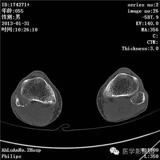 【病例】腓骨骨巨细胞瘤1例CT影像表现 【病例】腓骨骨巨细胞瘤1例CT影像表现