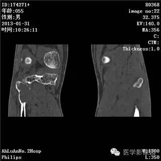 【病例】腓骨骨巨细胞瘤1例CT影像表现 【病例】腓骨骨巨细胞瘤1例CT影像表现
