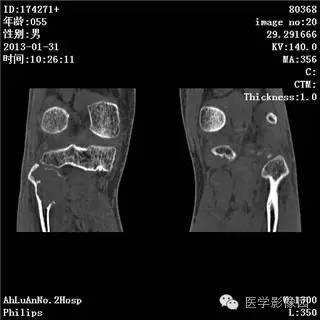 【病例】腓骨骨巨细胞瘤1例CT影像表现 【病例】腓骨骨巨细胞瘤1例CT影像表现