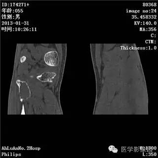 【病例】腓骨骨巨细胞瘤1例CT影像表现 【病例】腓骨骨巨细胞瘤1例CT影像表现