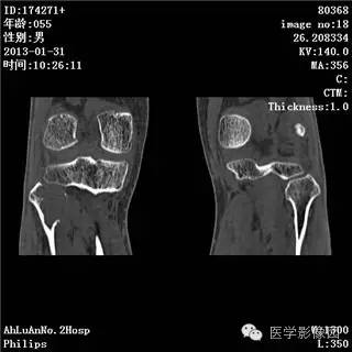【病例】腓骨骨巨细胞瘤1例CT影像表现 【病例】腓骨骨巨细胞瘤1例CT影像表现