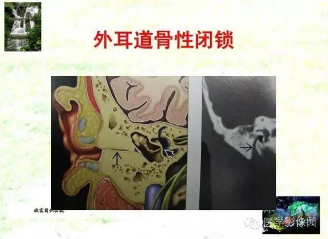 【PPT】颞骨畸形的CT诊断