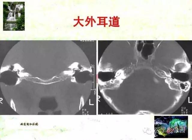 【PPT】颞骨畸形的CT诊断