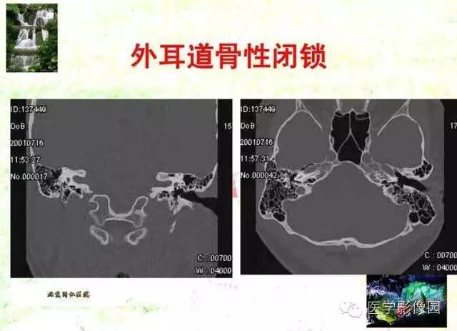 【PPT】颞骨畸形的CT诊断