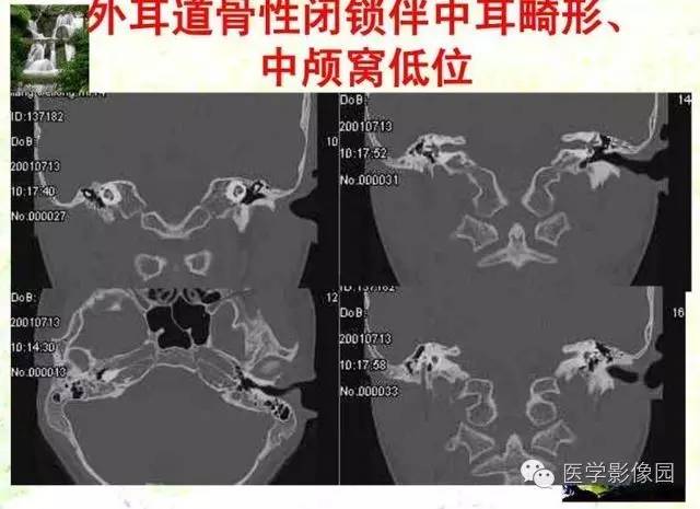 【PPT】颞骨畸形的CT诊断