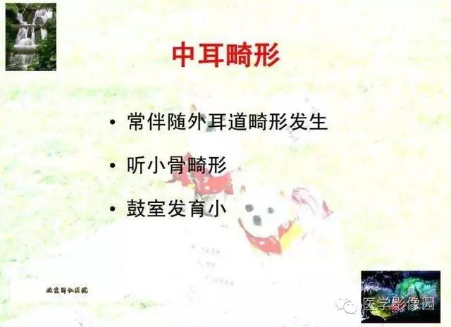 【PPT】颞骨畸形的CT诊断