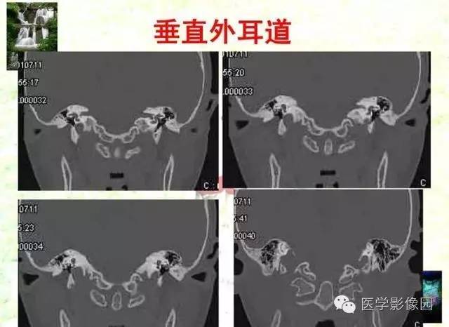 【PPT】颞骨畸形的CT诊断