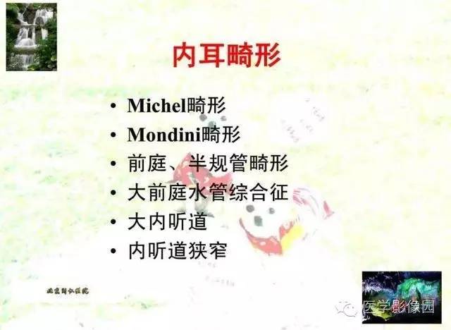【PPT】颞骨畸形的CT诊断