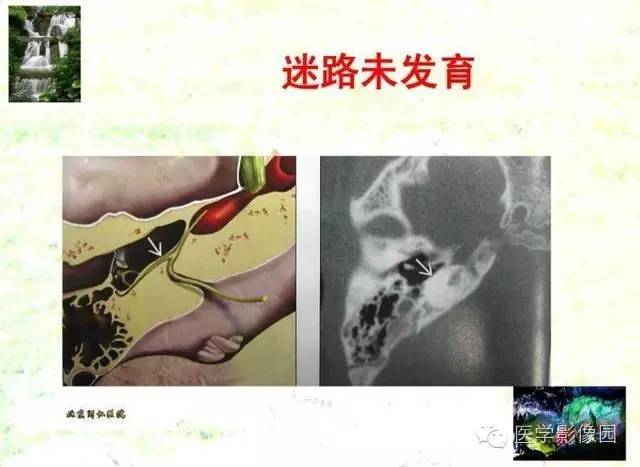 【PPT】颞骨畸形的CT诊断