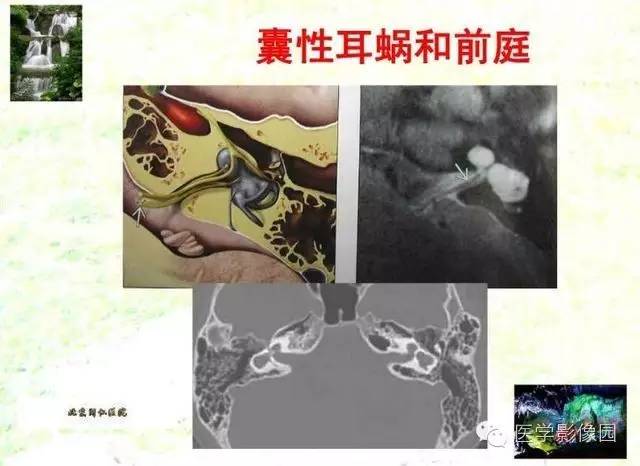 【PPT】颞骨畸形的CT诊断