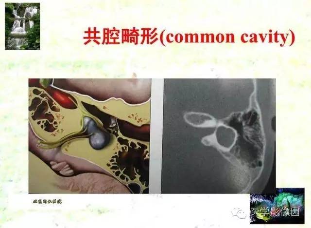 【PPT】颞骨畸形的CT诊断