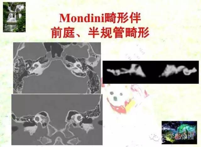 【PPT】颞骨畸形的CT诊断