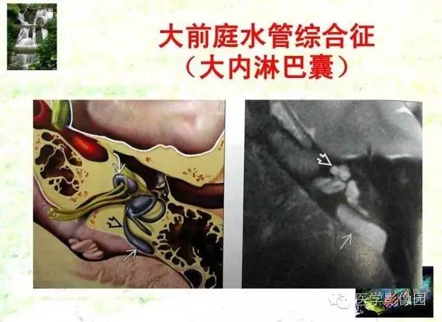 【PPT】颞骨畸形的CT诊断
