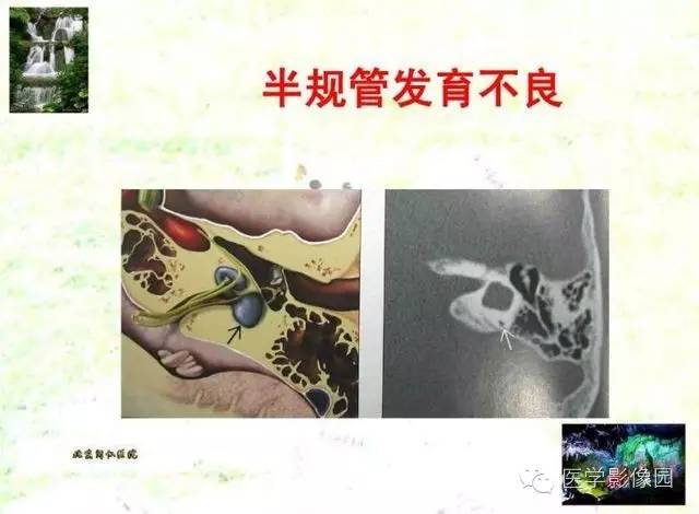 【PPT】颞骨畸形的CT诊断
