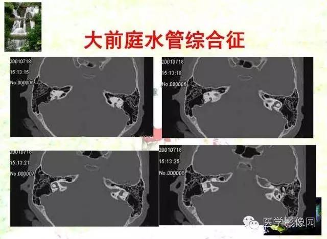 【PPT】颞骨畸形的CT诊断