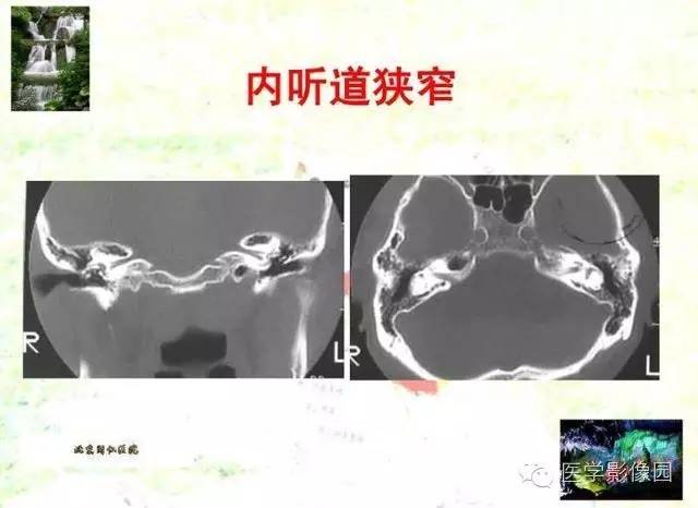 【PPT】颞骨畸形的CT诊断