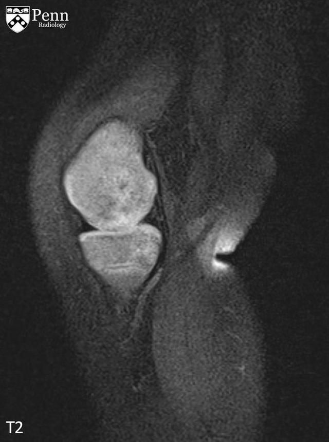 【病例】半肢骨骺发育异常1例X线影像表现 【病例】半肢骨骺发育异常1例X线影像表现