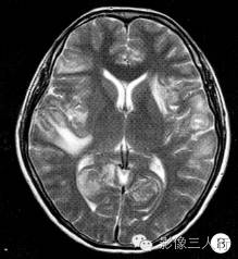 【病例】脑及脑膜弥漫性大B细胞淋巴瘤1例MR影像表现 【病例】脑及脑膜弥漫性大B细胞淋巴瘤1例MR影像表现