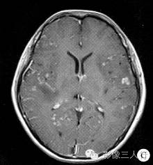 【病例】脑及脑膜弥漫性大B细胞淋巴瘤1例MR影像表现 【病例】脑及脑膜弥漫性大B细胞淋巴瘤1例MR影像表现