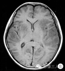 【病例】脑及脑膜弥漫性大B细胞淋巴瘤1例MR影像表现 【病例】脑及脑膜弥漫性大B细胞淋巴瘤1例MR影像表现