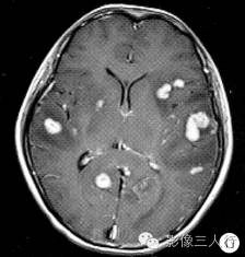 【病例】脑及脑膜弥漫性大B细胞淋巴瘤1例MR影像表现 【病例】脑及脑膜弥漫性大B细胞淋巴瘤1例MR影像表现