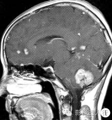 【病例】脑及脑膜弥漫性大B细胞淋巴瘤1例MR影像表现 【病例】脑及脑膜弥漫性大B细胞淋巴瘤1例MR影像表现