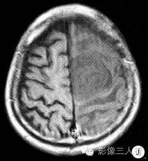 【病例】脑及脑膜弥漫性大B细胞淋巴瘤1例MR影像表现 【病例】脑及脑膜弥漫性大B细胞淋巴瘤1例MR影像表现
