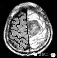【病例】脑及脑膜弥漫性大B细胞淋巴瘤1例MR影像表现 【病例】脑及脑膜弥漫性大B细胞淋巴瘤1例MR影像表现