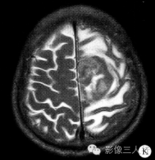 【病例】脑及脑膜弥漫性大B细胞淋巴瘤1例MR影像表现 【病例】脑及脑膜弥漫性大B细胞淋巴瘤1例MR影像表现
