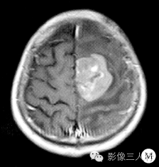 【病例】脑及脑膜弥漫性大B细胞淋巴瘤1例MR影像表现 【病例】脑及脑膜弥漫性大B细胞淋巴瘤1例MR影像表现