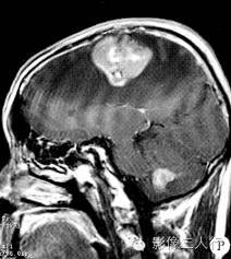 【病例】脑及脑膜弥漫性大B细胞淋巴瘤1例MR影像表现 【病例】脑及脑膜弥漫性大B细胞淋巴瘤1例MR影像表现