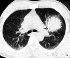 【病例】肺粘膜相关淋巴组织淋巴瘤1例CT影像表现