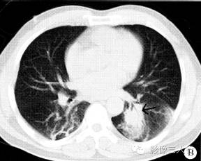【病例】肺粘膜相关淋巴组织淋巴瘤1例CT影像表现 【病例】肺粘膜相关淋巴组织淋巴瘤1例CT影像表现