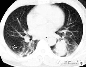 【病例】肺粘膜相关淋巴组织淋巴瘤1例CT影像表现 【病例】肺粘膜相关淋巴组织淋巴瘤1例CT影像表现