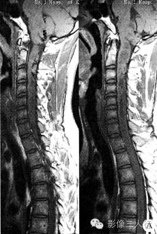 【病例】颈椎髓内血管网状细胞瘤1例MR影像表现