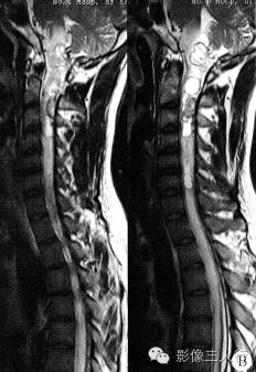【病例】颈椎髓内血管网状细胞瘤1例MR影像表现 【病例】颈椎髓内血管网状细胞瘤1例MR影像表现