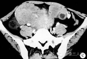 【病例】双侧卵巢无性细胞瘤1例CT影像表现 【病例】双侧卵巢无性细胞瘤1例CT影像表现