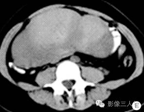 【病例】双侧卵巢无性细胞瘤1例CT影像表现 【病例】双侧卵巢无性细胞瘤1例CT影像表现