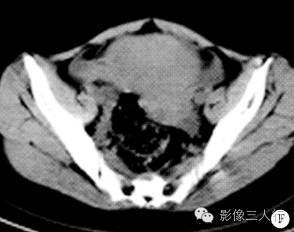 【病例】双侧卵巢无性细胞瘤1例CT影像表现 【病例】双侧卵巢无性细胞瘤1例CT影像表现