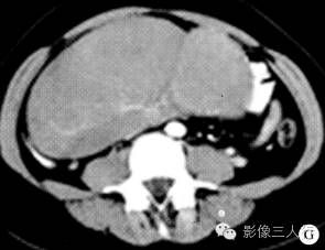 【病例】双侧卵巢无性细胞瘤1例CT影像表现 【病例】双侧卵巢无性细胞瘤1例CT影像表现