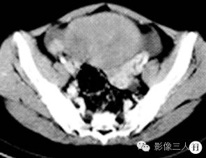 【病例】双侧卵巢无性细胞瘤1例CT影像表现 【病例】双侧卵巢无性细胞瘤1例CT影像表现
