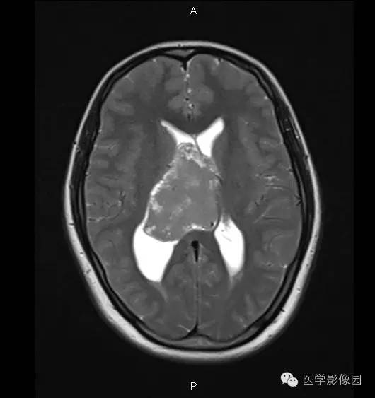 【病例】侧脑室中枢神经细胞瘤1例MR影像表现