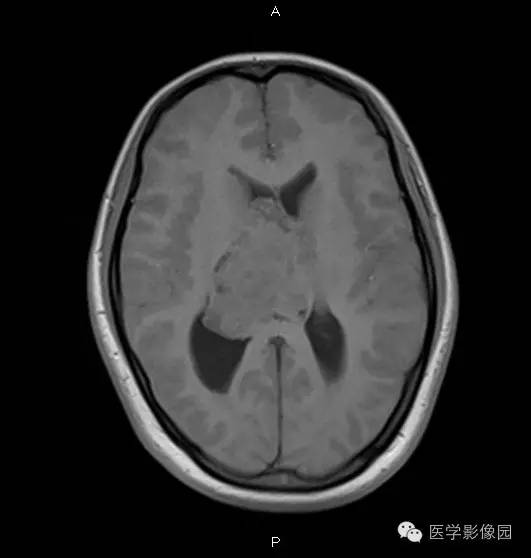 【病例】侧脑室中枢神经细胞瘤1例MR影像表现