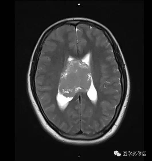 【病例】侧脑室中枢神经细胞瘤1例MR影像表现