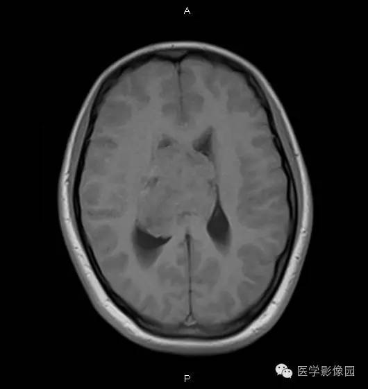 【病例】侧脑室中枢神经细胞瘤1例MR影像表现