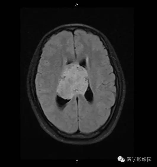 【病例】侧脑室中枢神经细胞瘤1例MR影像表现