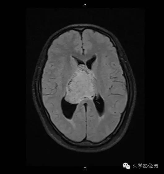 【病例】侧脑室中枢神经细胞瘤1例MR影像表现