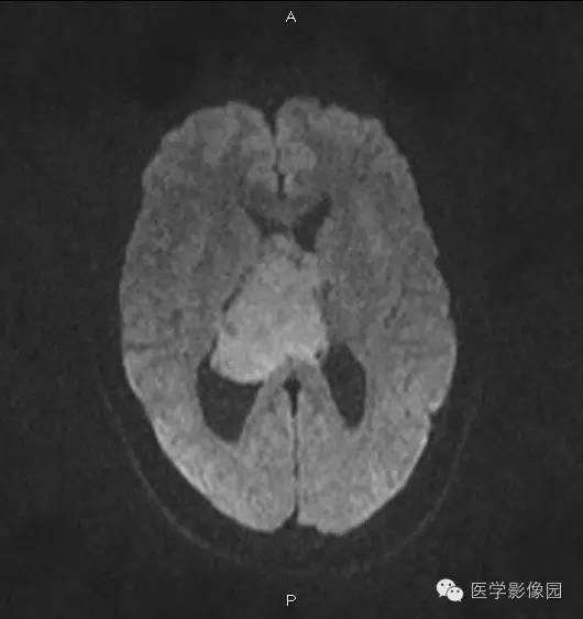 【病例】侧脑室中枢神经细胞瘤1例MR影像表现