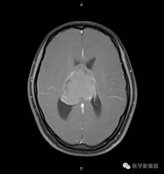 【病例】侧脑室中枢神经细胞瘤1例MR影像表现